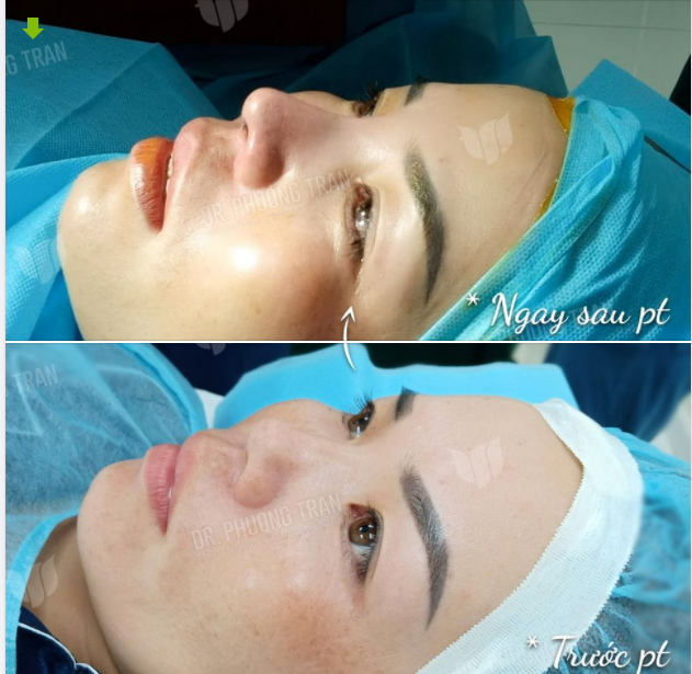 NẾU BẠN MUỐN NÂNG MŨI NHƯNG DA MŨI MỎNG……ĐỪNG BỎ QUA BÀI VIẾT NÀY
