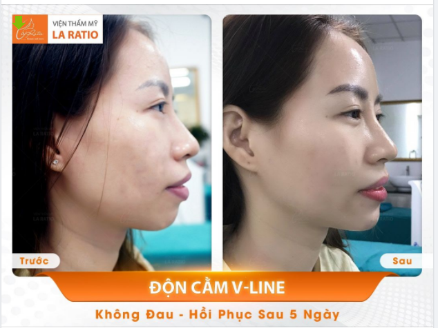 Ngắm nhìn hình ảnh khách hàng sau 45 phút thực hiện độn cằm