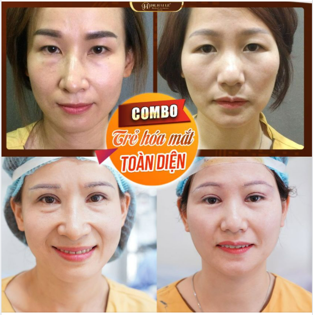 Ngày mới soi gương lại THẤY MÌNH TRẺ RA là thế nào nhỉ? Chắc chắn những khách nào đến Dr.Hải Lê làm combo trẻ hóa đôi mắt thì sẽ có cảm giác này đúng chưa ạ