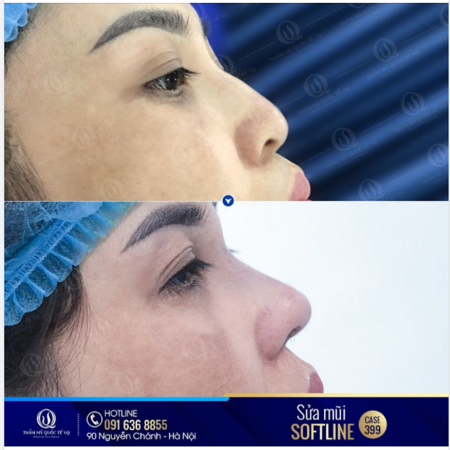 Ngoài kia trăm ngả lối về, mũi mà làm hỏng thì về VQ