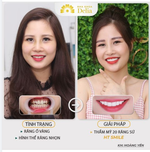 NGƯỜI ĐẸP VÌ LỤA, CƯỜI ĐẸP NHỜ THẨM MỸ RĂNG SỨ TẠI DELIA