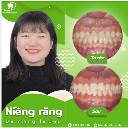 NHA KHOA THÙY ANH - ĐÃ NIỀNG LÀ PHẢI ĐẸP