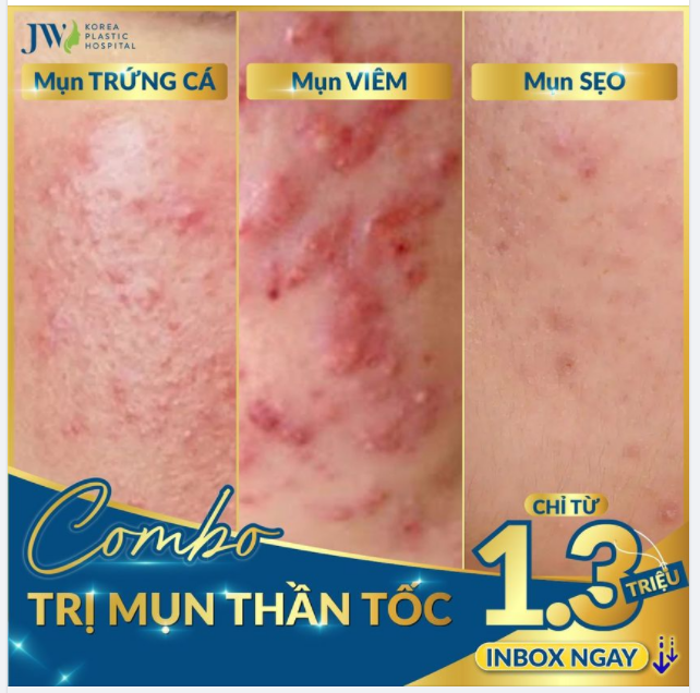 NHÀ TÔI BA ĐỜI KHÔNG MỤN ĐẾN ĐỜI TÔI MỤN MỌC LI TI