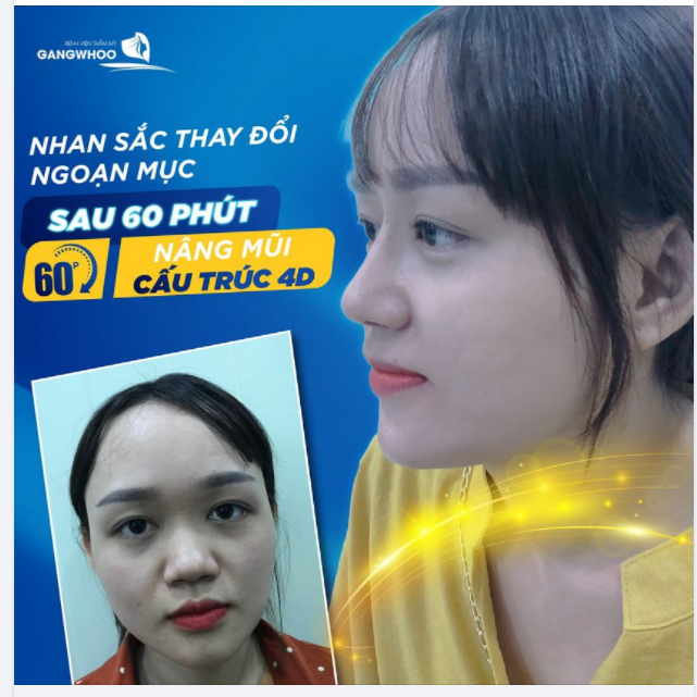 NHAN SẮC THAY ĐỔI NGOẠN MỤC SAU 60 PHÚT NÂNG MŨI (CẤU TRÚC 4D)