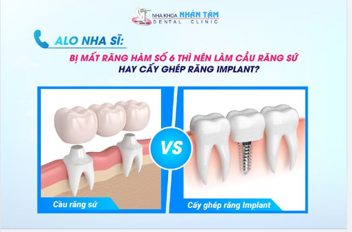 Nhân Tâm là trung tâm nha khoa đầu tiên thực hiện thành công kỹ thuật cấy ghép răng Implant bằng công nghệ định vị tại Việt Nam và Đông Nam Á.