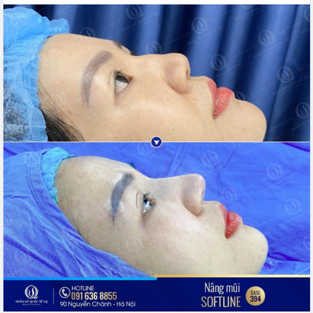 Nhấp nhô sóng mũi gập gồ - sửa xong dáng mũi lộc vồ tới ngay