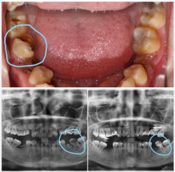 Nhiều bệnh nhân, và kể cả bác sĩ, đã từng nghĩ rằng "chiếc răng này làm sao giữ lại nổi?"