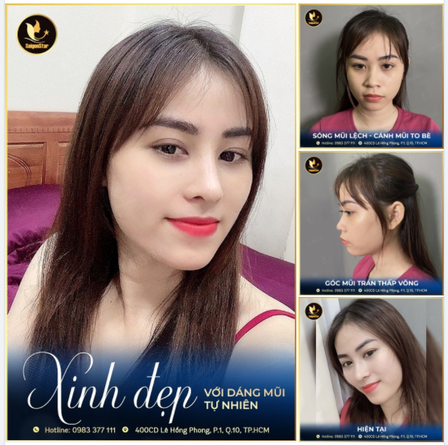 Nhiều khách hàng chia sẻ "thích nhất cảm giác, sau nâng mũi nhưng được khen là mũi đẹp tự nhiên".