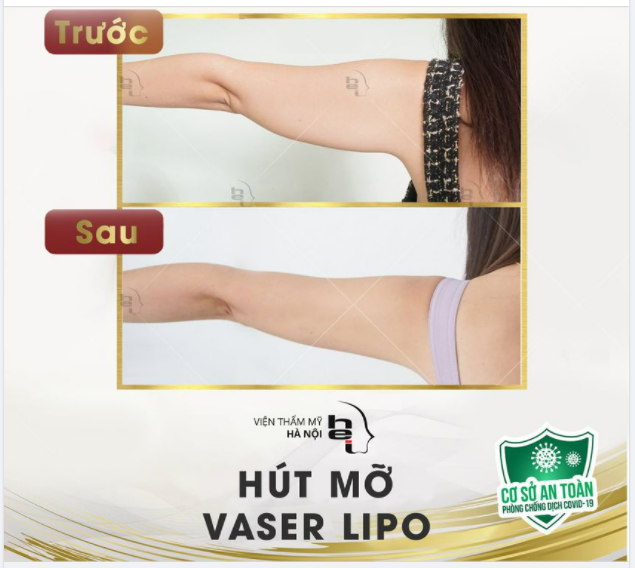 Nhìn tay thon đoán ngay dịch vụ!!!!! Không giống như các vùng hút mỡ khác, hút mỡ cánh tay hoàn toàn nhẹ nhàng như "không"