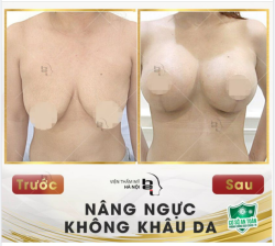 Nhìn tình trạng trước khi nâng cấp V1 của chị khách hàng mà bác sĩ thấy thương quá!