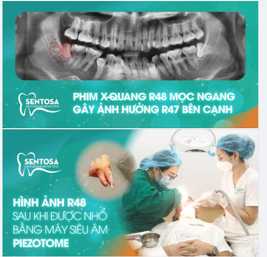 NHỔ RĂNG KHÔN – ĐÃ CÓ MÁY SIÊU ÂM  PIEZOTOME