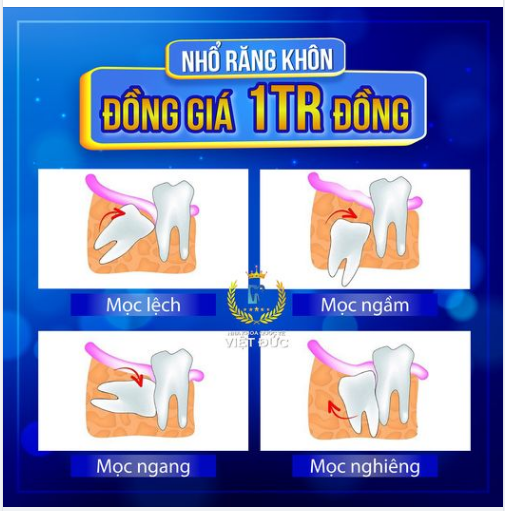 NHỔ RĂNG KHÔN ĐỒNG GIÁ CHỈ 1 TRIỆU ĐỒNG THỨ 3 HÀNG TUẦN