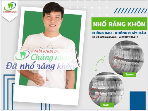NHỔ RĂNG KHÔN NHẸ NHÀNG HƠN VỚI MÁY RUNG SIÊU ÂM PIEZOTOME