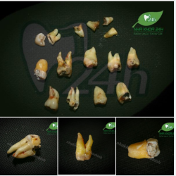 NHỔ RĂNG KHÔN TRƯỚC KHI QUÁ MUỘN