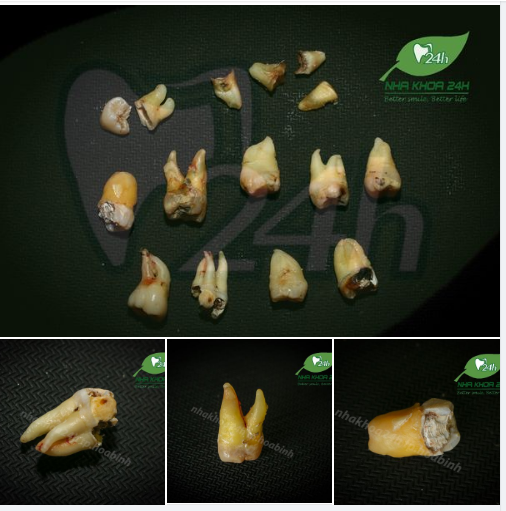 NHỔ RĂNG KHÔN TRƯỚC KHI QUÁ MUỘN