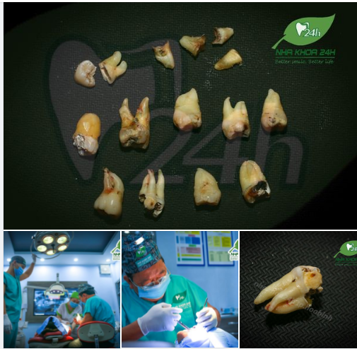 NHỔ RĂNG KHÔN TRƯỚC KHI QUÁ MUỘN