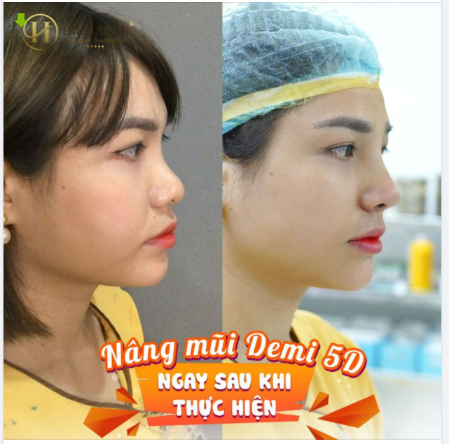 NHỮNG BẤT AN VỀ KẾT QUẢ NÂNG MŨI ĐỀU ĐƯỢC GIẢI QUYẾT VỚI NÂNG MŨI DEMI 5D