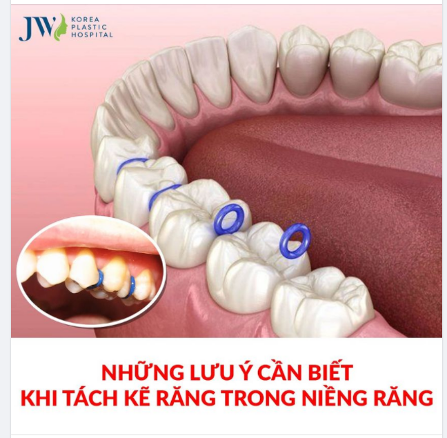 Những điều bạn cần biết về TÁCH KẼ RĂNG trong niềng răng