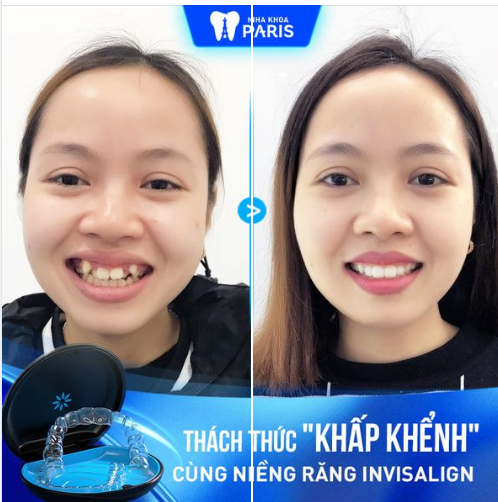 NIỀNG 6 THÁNG HẾT KHẤP KHỂNH