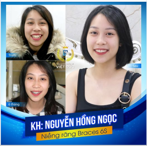 NIỀNG RĂNG 1 LẦN - CƯỜI ĐẸP TRỌN 1 ĐỜI