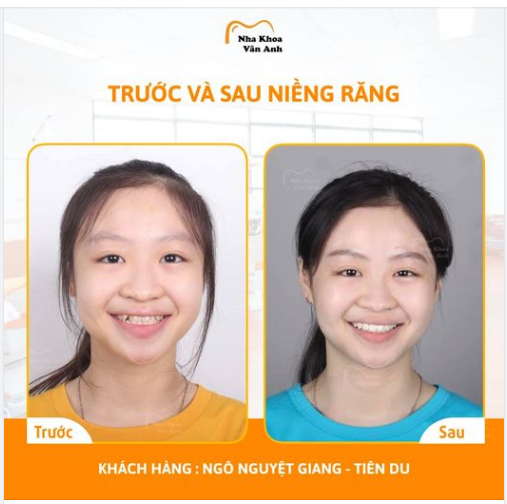 NIỀNG RĂNG CÀNG SỚM - CÀNG CÓ LỢI