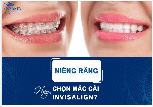 NIỀNG RĂNG CHỌN MẮC CÀI HAY INVISALIGN