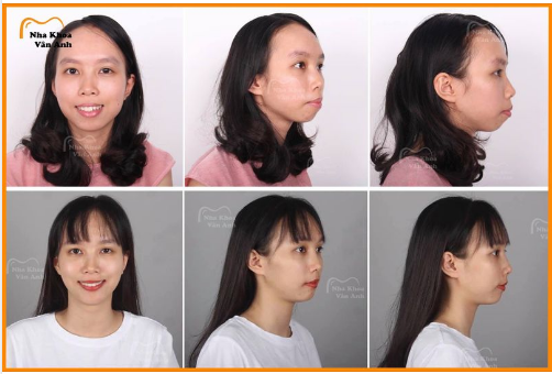 NIỀNG RĂNG CÓ LÀM THAY ĐỔI KHUÔN MẶT KHÔNG?