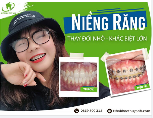 NIỀNG RĂNG ĐÃ GIÚP TÔI CÓ HÀM RĂNG ĐỀU ĐẸP NHƯ THẾ NÀO?