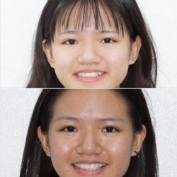 Niềng răng dựa vào sự phát triển xương hàm của trẻ em, giúp trẻ tăng trưởng chiều cao mà kết quả niềng lại tốt nhất