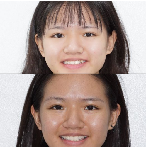 Niềng răng dựa vào sự phát triển xương hàm của trẻ em, giúp trẻ tăng trưởng chiều cao mà kết quả niềng lại tốt nhất