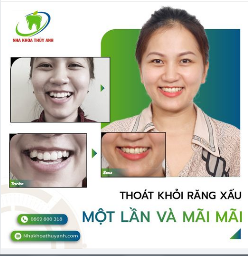 NIỀNG RĂNG F5 BẢN THÂN, F5 NỤ CƯỜI - CHƯA BAO GIỜ LÀ QUÁ MUỘN