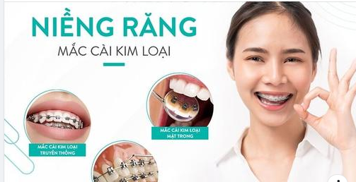 NIỀNG RĂNG GIÁ BAO NHIÊU TIỀN?