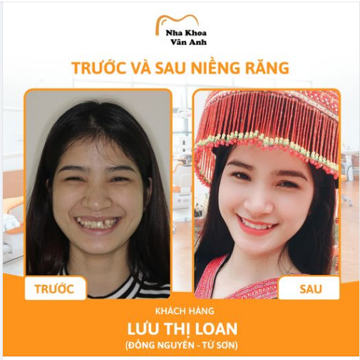 NIỀNG RĂNG - HÀNH TRÌNH ĐỂ CÓ HÀM RĂNG ĐẸP