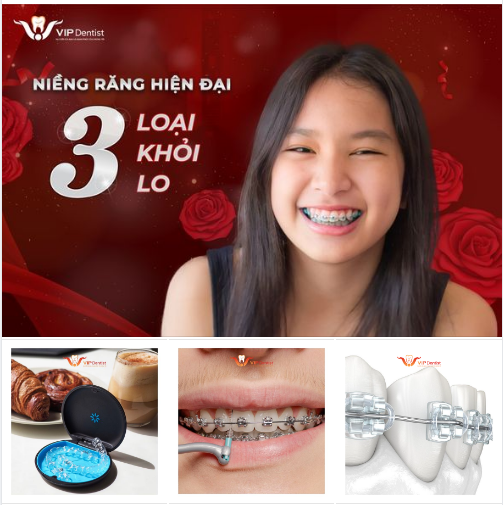NIỀNG RĂNG HIỆN ĐẠI - 3 LOẠI KHỎI LO