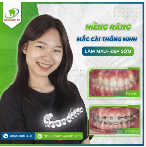 NIỀNG RĂNG HÔM NAY CÓ RĂNG ĐẸP LIỀN NGAY