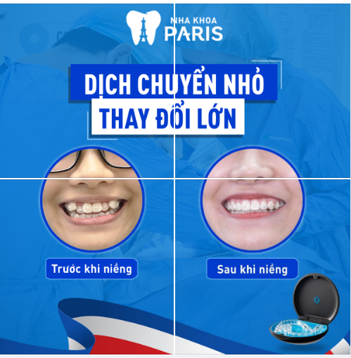 NIỀNG RĂNG INVISALIGN  BÍ KÍP CƯỜI XINH - LUNG LINH ĐÓN HÈ