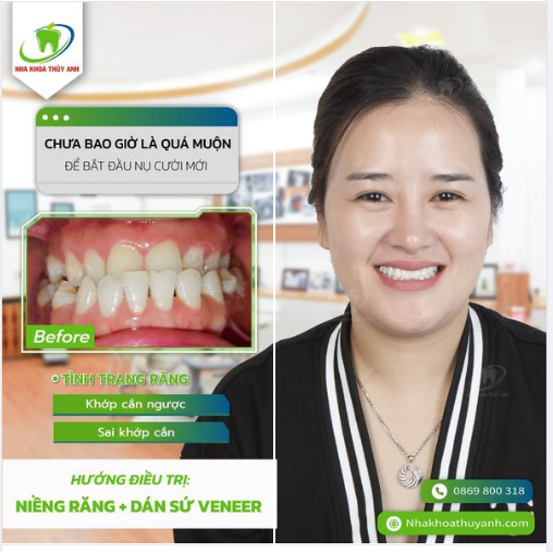 NIỀNG RĂNG KẾT HỢP DÁN SỨ VENEER THAY ĐỔI HOÀN TOÀN HÀM RĂNG CŨ