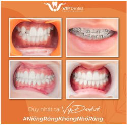 NIỀNG RĂNG KHÔNG NHỔ RĂNG - DUY NHẤT TẠI VIP DENTIST