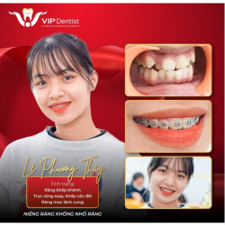 NIỀNG RĂNG KHÔNG NHỔ RĂNG - SỰ THAY ĐỔI DIỆU KỲ