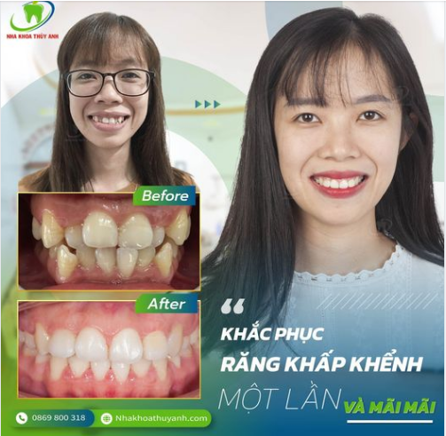 NIỀNG RĂNG LỆCH LẠC - RĂNG ĐỀU ĐẸP CHỈ SAU 3 THÁNG NIỀNG RĂNG