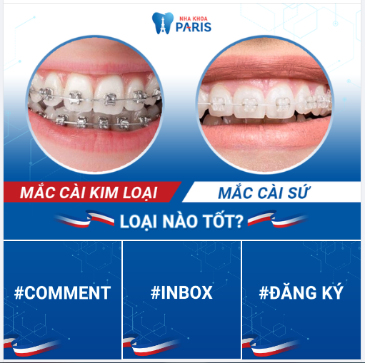 Niềng răng mắc cài - Chọn kim loại hay sứ?