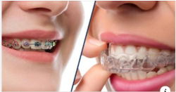 NIỀNG RĂNG MẮC CÀI KIM LOẠI VÀ KHAY CHỈNH NHA INVISALIGN CÓ GÌ KHÁC NHAU