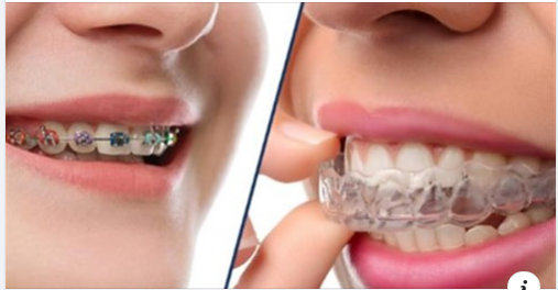 NIỀNG RĂNG MẮC CÀI KIM LOẠI VÀ KHAY CHỈNH NHA INVISALIGN CÓ GÌ KHÁC NHAU