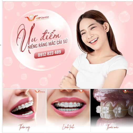 NIỀNG RĂNG MẮC CÀI SỨ - NHỮNG ƯU ĐIỂM KHIẾN BẠN NGHE XONG CHỌN NGAY