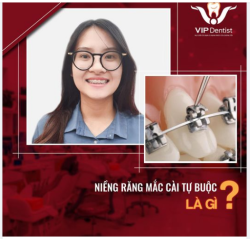 NIỀNG RĂNG MẮC CÀI TỰ BUỘC LÀ GÌ?