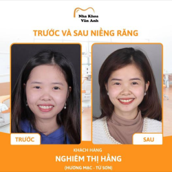 NIỀNG RĂNG MẮC CÀI TỰ BUỘC -