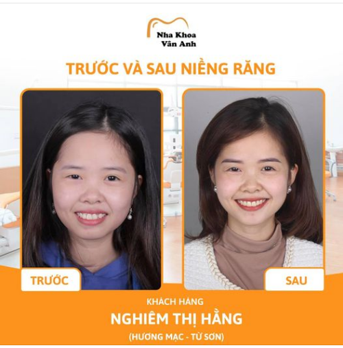NIỀNG RĂNG MẮC CÀI TỰ BUỘC -