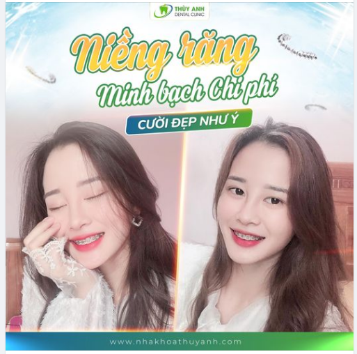 NIỀNG RĂNG MINH BẠCH CHI PHÍ CƯỜI ĐẸP NHƯ Ý