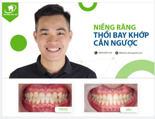 NIỀNG RĂNG MÓM - SỰ LỰA CHỌN SÁNG SUỐT CỦA BẠN