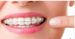 Niềng răng một hàm là như thế nào - Trường hợp nào làm được và có hiệu quả không 